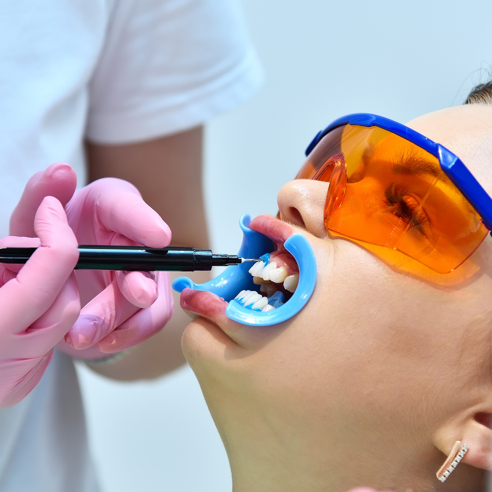 Barreras Gingivales