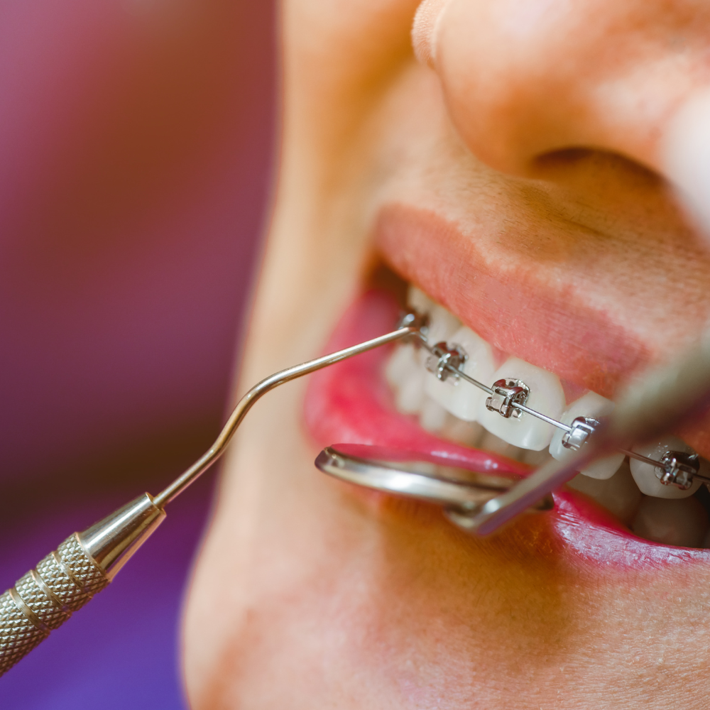 Brackets de Autoligado