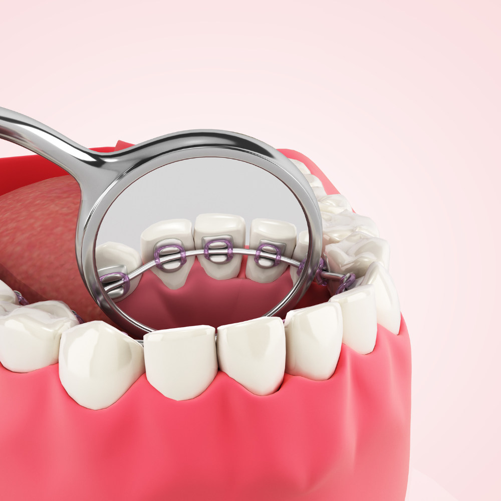 Brackets Linguales