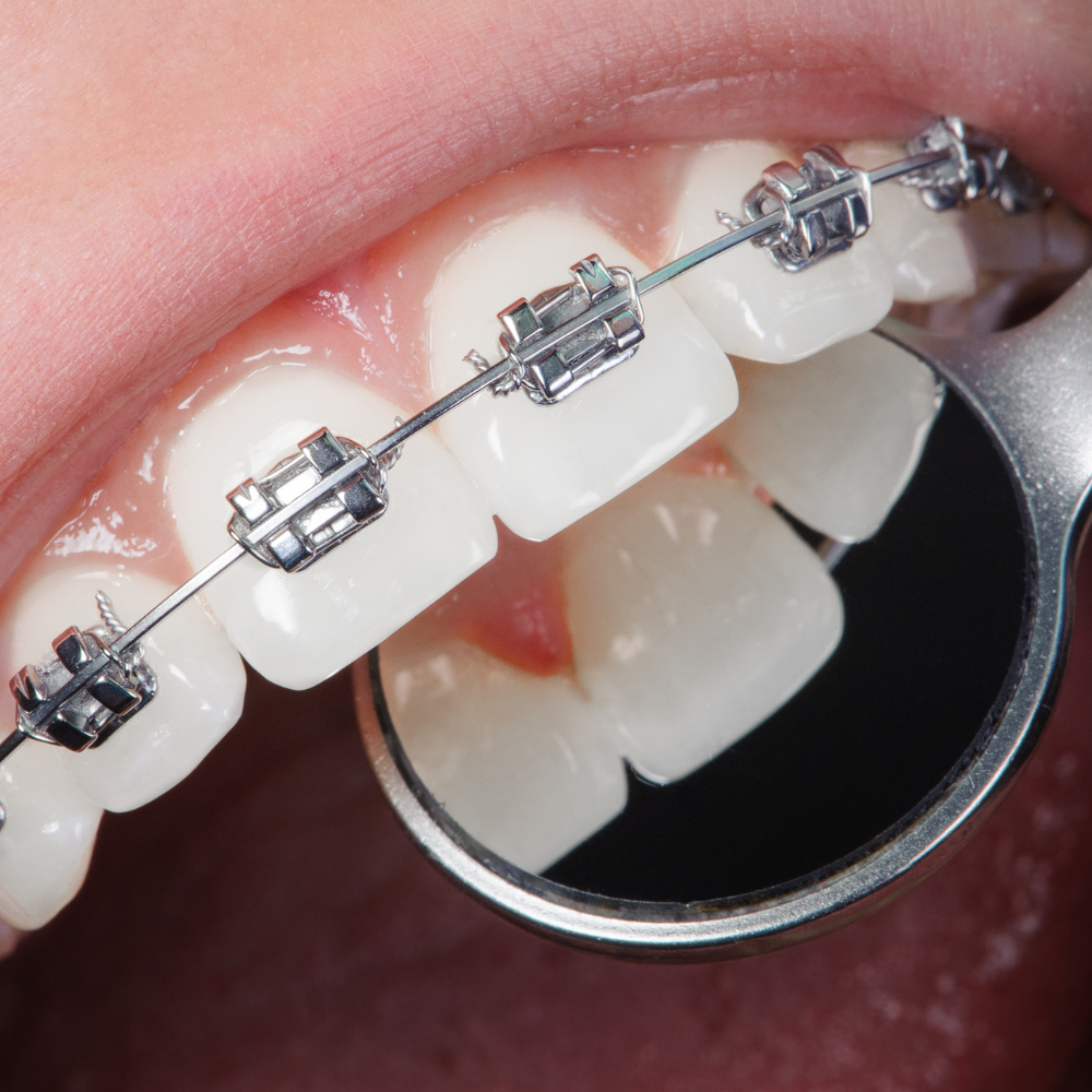 Brackets Metálicos