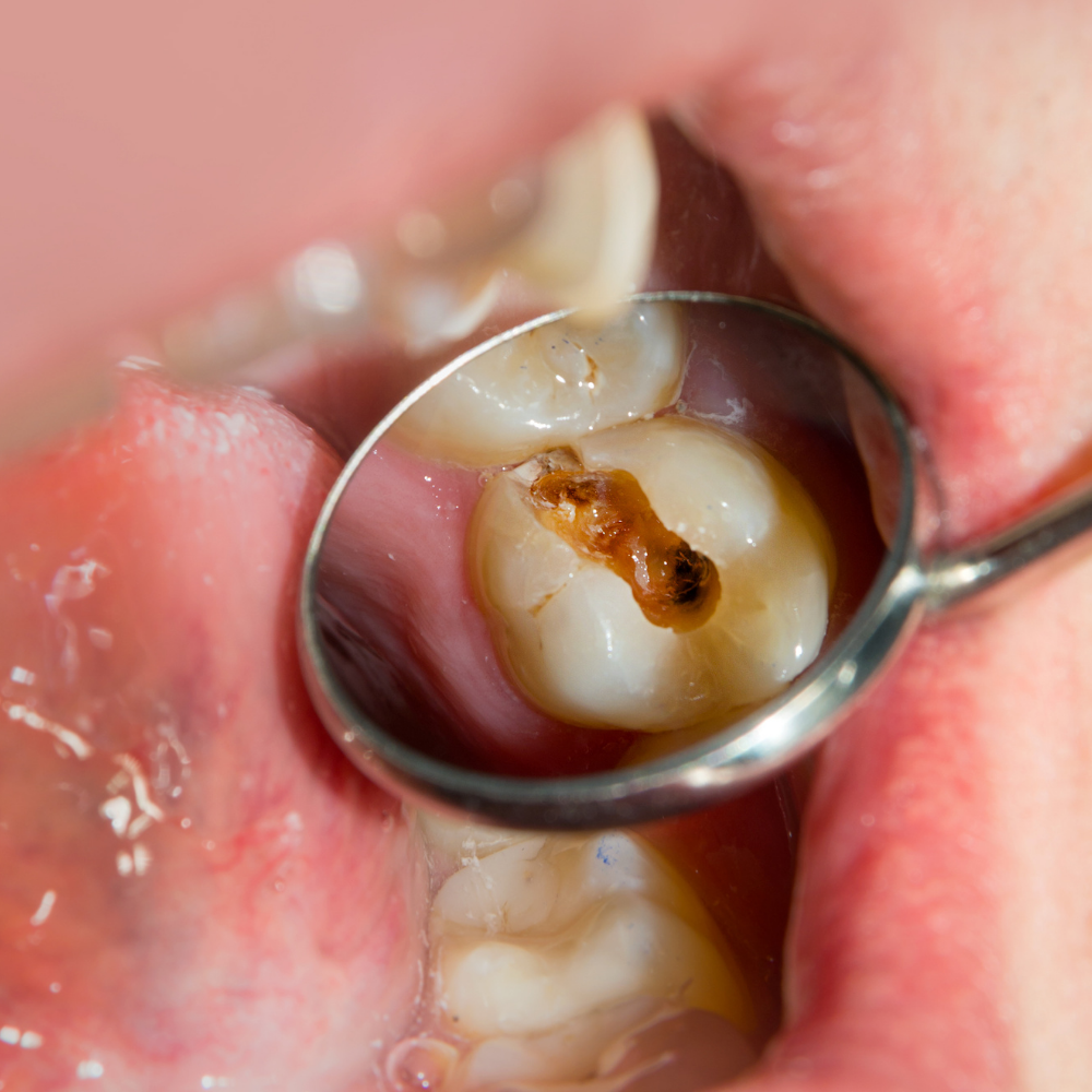 Detector de caries