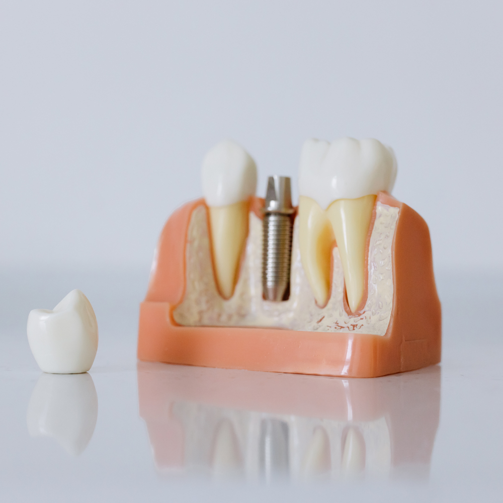 Implantes de Conexión Externa