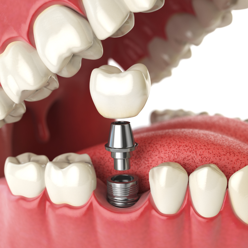 Implantes de Conexión Interna