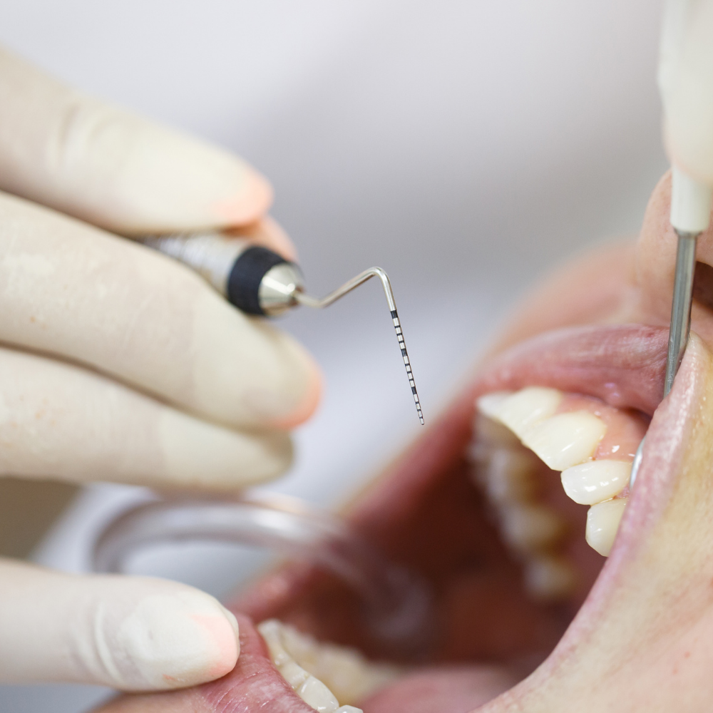 Insertos para Periodoncia
