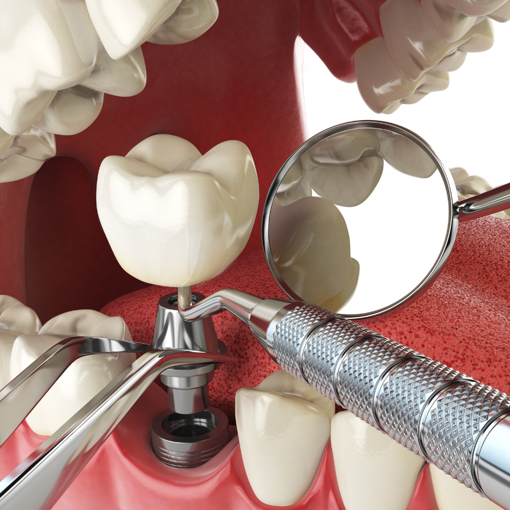 Instrumental para Implantes