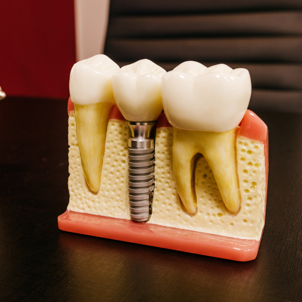 Motores de Implantes