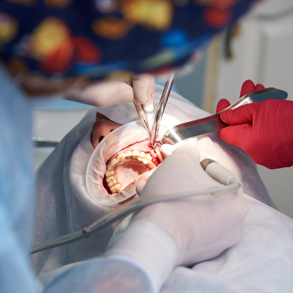Piezoeléctricos cirugía dental
