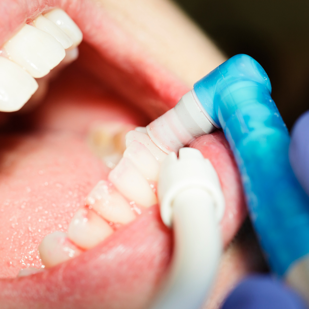 Profilaxis Dental