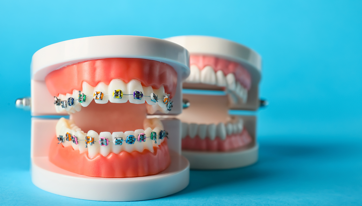 Clasificación de los brackets dentales