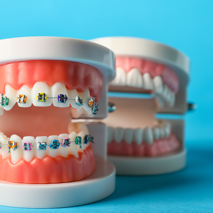 Clasificación de los brackets dentales