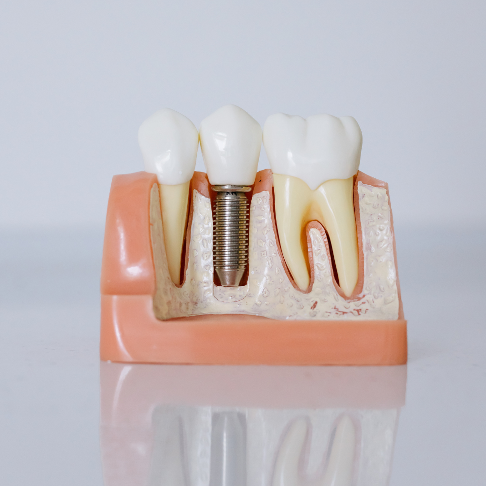 Accesorios para Implantes de Conexión Externa